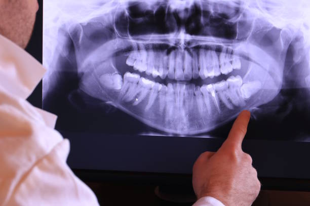Best Emergency Wisdom Teeth Removal in Ben Avon, SC